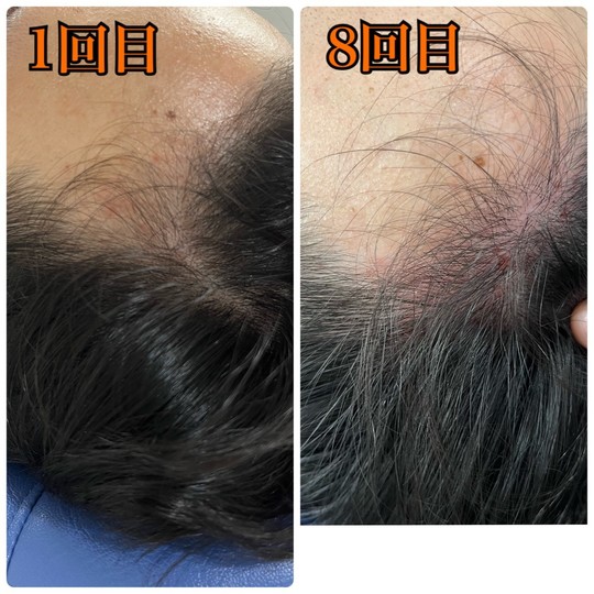 薄毛改善鍼　before After　おでこの髪の毛が8回目で髪の毛が生えてきた