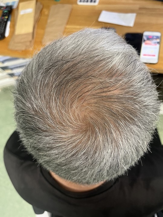 60歳代男性の薄毛改善鍼　頭頂部のAfter
