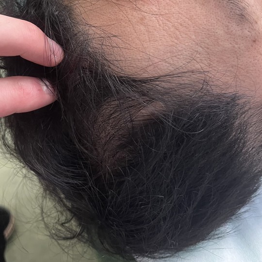 40代男性の薄毛改善鍼の施術後