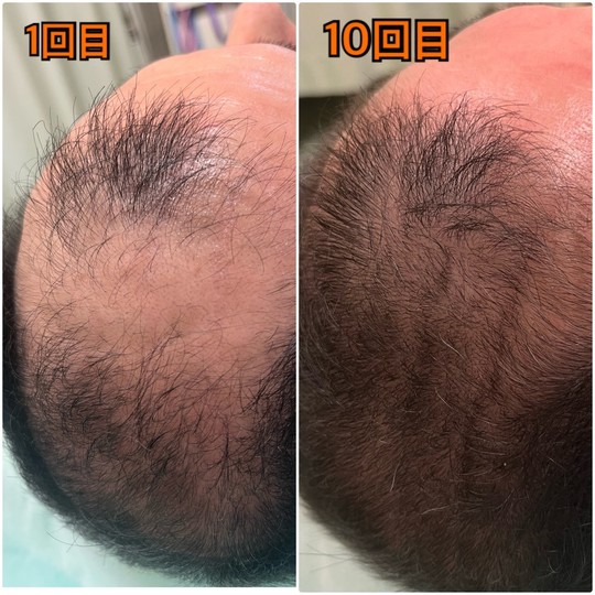 頭頂部の薄毛に悩んでいる50代男性の薄毛改善鍼を受けた1回目、10回目の写真