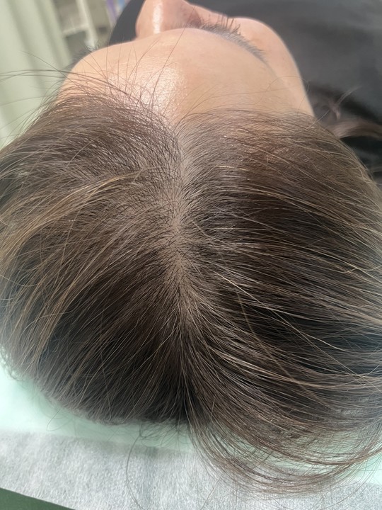 40歳代女性の頭頂部薄毛改善鍼の施術前　1回目
