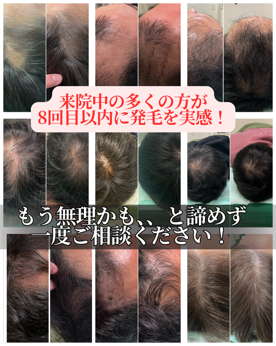 姫路市のオオヤ鍼灸整骨院で行う薄毛・抜け毛に対する薄毛改善鍼治療の施術経過例