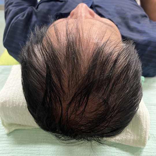 50代男性の薄毛改善鍼の施術前