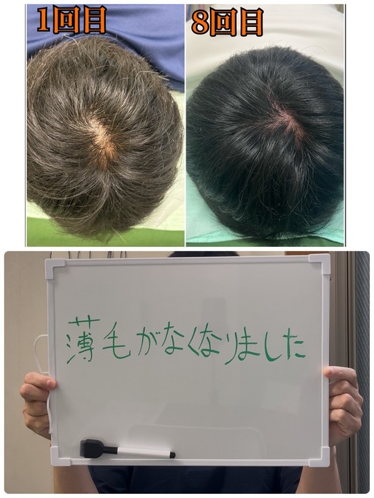 後頭部の薄毛で来院されている40代男性のお客様の声