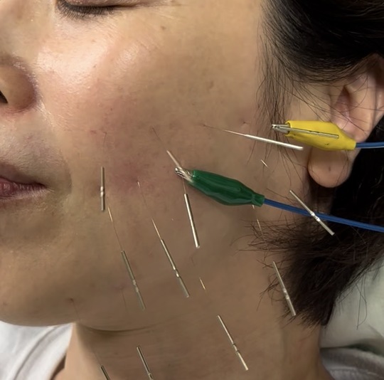 姫路市からご来院の顎関節症による顎の痛みでお困りの40歳代女性