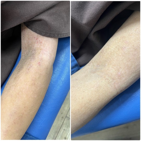 長年の肩こりでお困りの方に効果が期待できる鍼治療