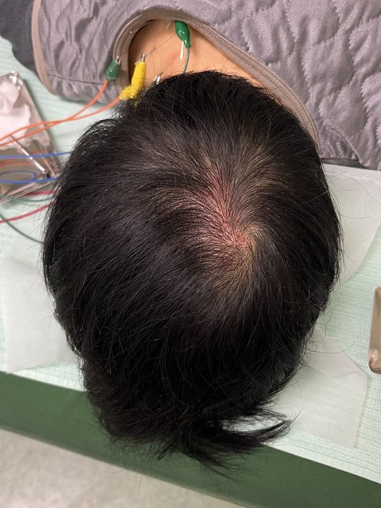 40歳代女性の頭頂部薄毛改善鍼の施術後　4回目