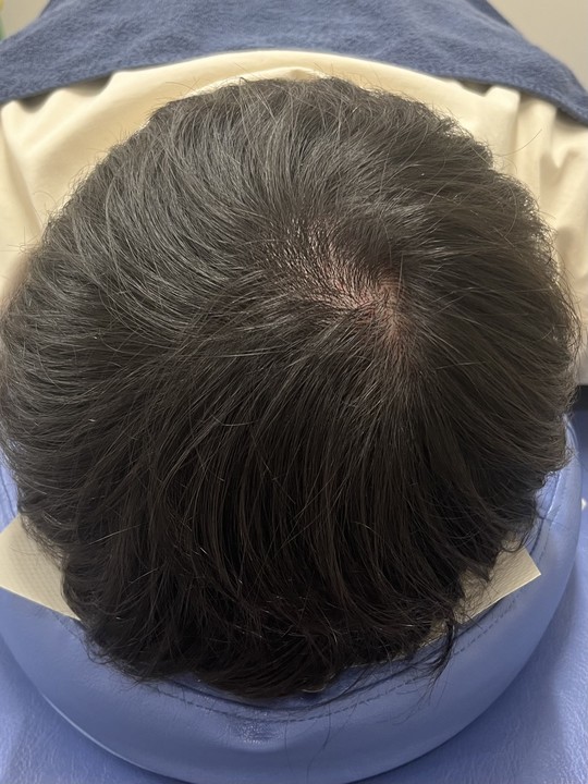 30代男性の頭頂部薄毛改善鍼の施術後