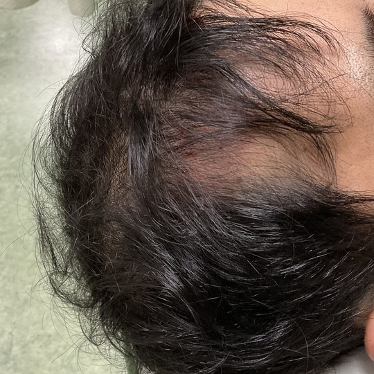 40代男性の薄毛改善鍼の施術前