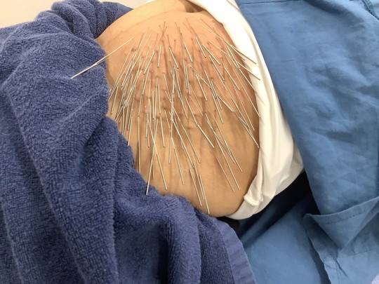 前髪、生え際の薄毛で来院されている50代男性のお客様の声