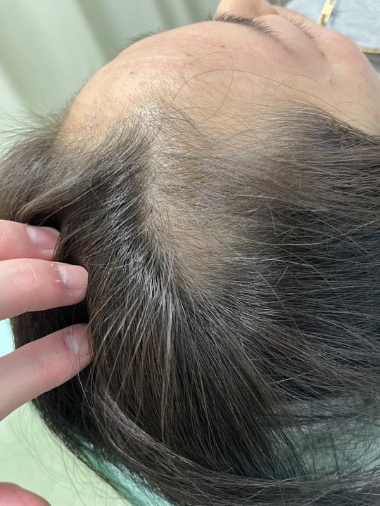 40代女性の円形脱毛症　薄毛改善鍼　施術後