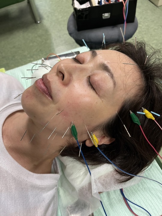 顎の筋肉の緊張を緩め顎の痛みを改善する電気鍼