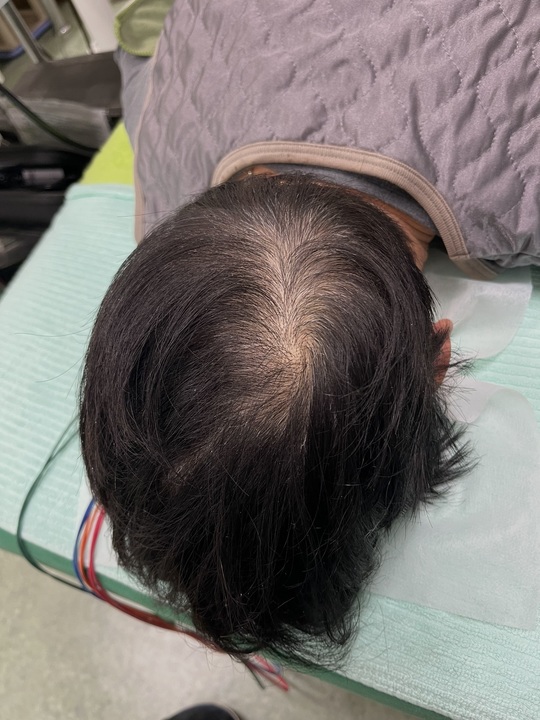 40歳代女性の頭頂部薄毛改善鍼の施術前　1回目