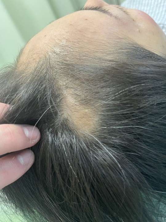 40代女性の側頭部の円形脱毛症　薄毛改善鍼の施術前