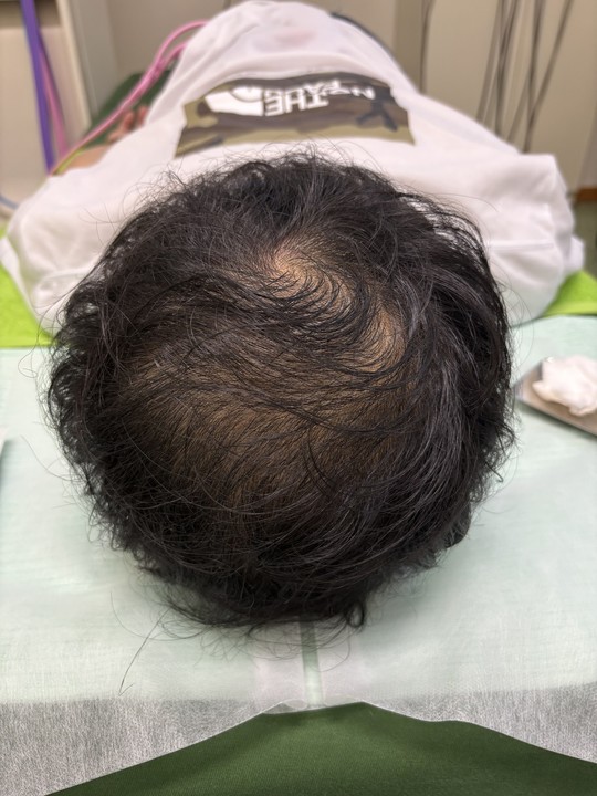 40代男性の薄毛改善鍼の施術前
