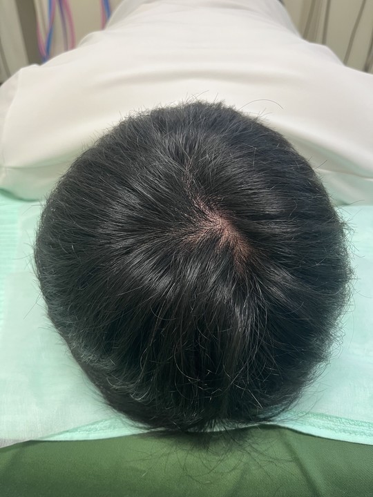 40歳代男性の薄毛改善鍼　頭頂部のAfter