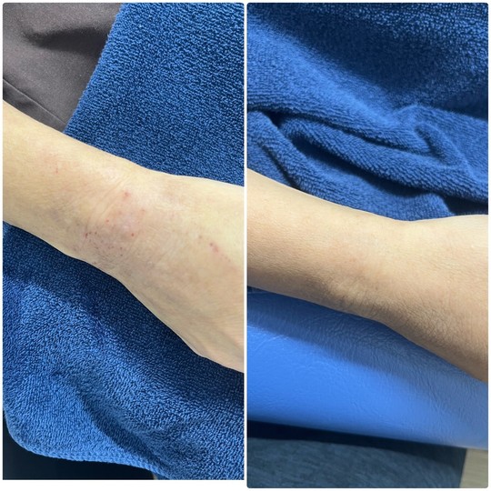 肩こりの原因になる大胸筋や小胸筋を緩める整体