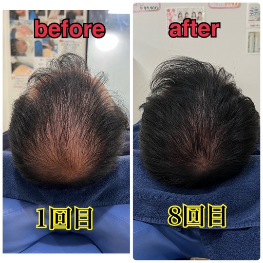 薄毛改善鍼　before After　頭のてっぺんが8回目で髪の毛が生えてきた