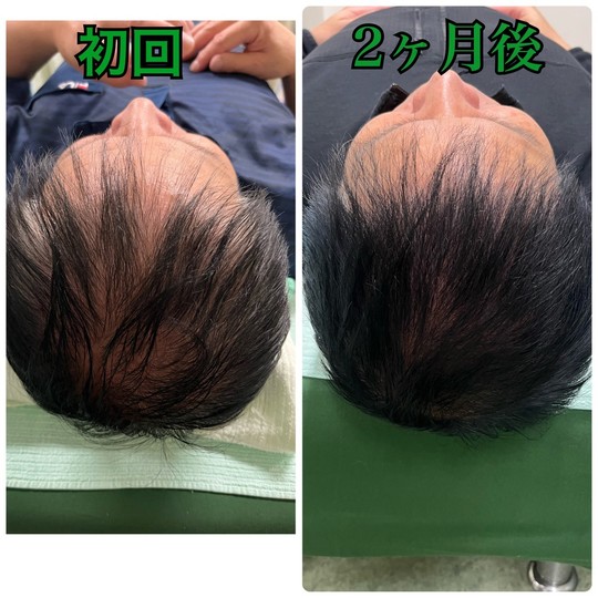 オオヤ鍼灸整骨院　姫路駅前店の薄毛改善鍼　2か月後に髪の毛が生えてきた写真