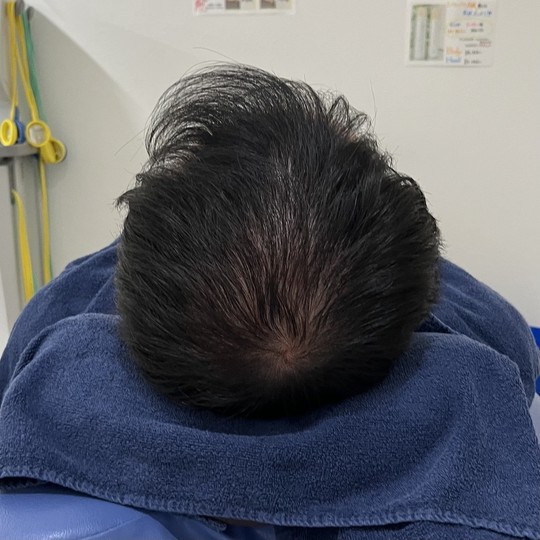40代男性の薄毛改善鍼　施術後