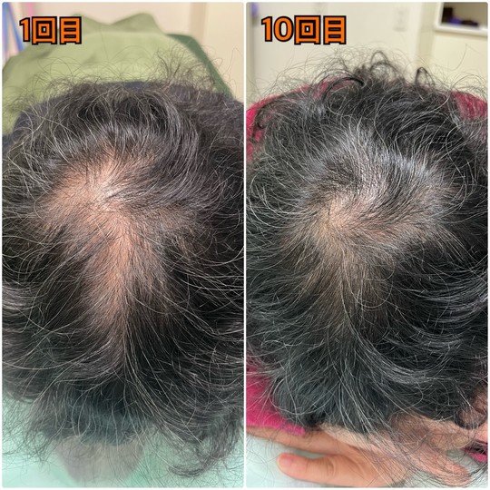 女性の薄毛、産後脱毛に悩んでいる方の薄毛改善鍼を受けたBA写真
