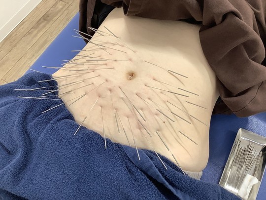 後頭部の薄毛で来院されている40代男性のお客様の声