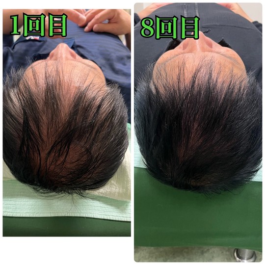 薄毛改善鍼　before After　M字ハゲが8回目で髪の毛が生えてきた