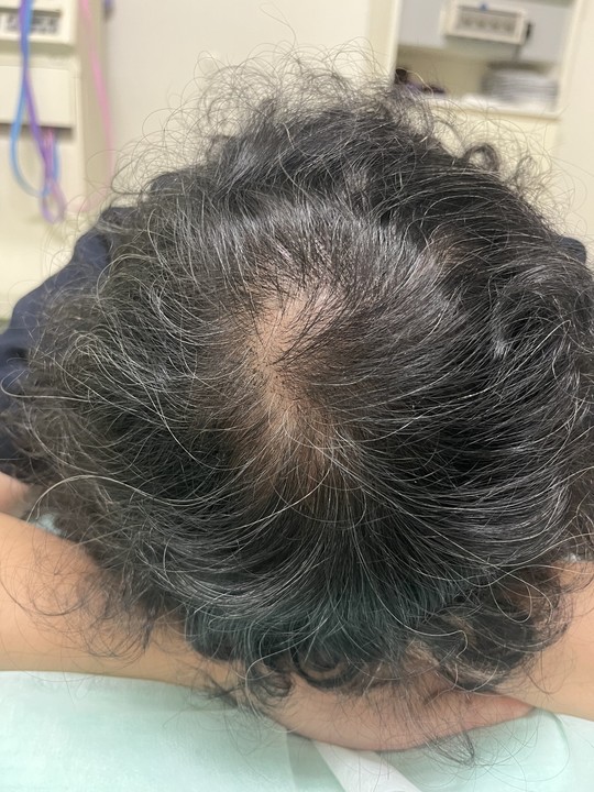 60歳代女性の薄毛改善鍼　頭頂部の施術後　5回目