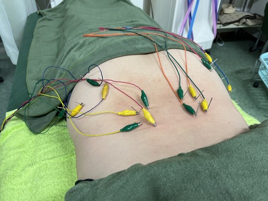ぎっくり腰で筋肉の緊張が起こっている場所に電気鍼を行っている