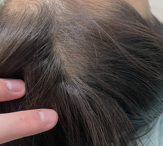 40歳代女性の円形脱毛症　薄毛改善鍼　10回目After
