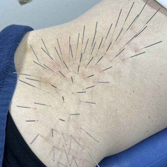 姫路で長年のこりやどこへ行っても治らなかった痛み、痺れを改善するルート鍼治療