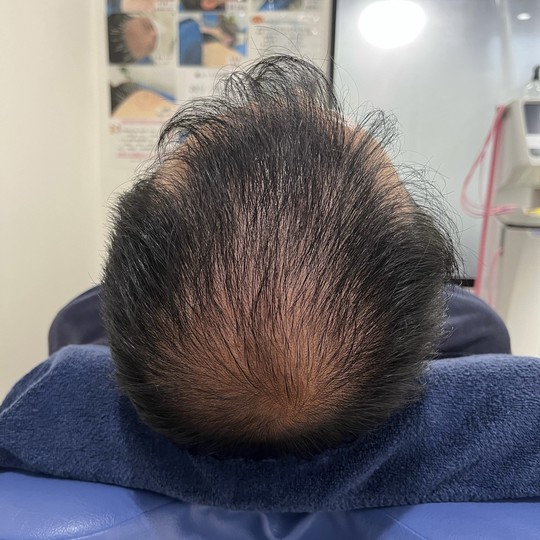 40代男性の薄毛改善鍼の施術前
