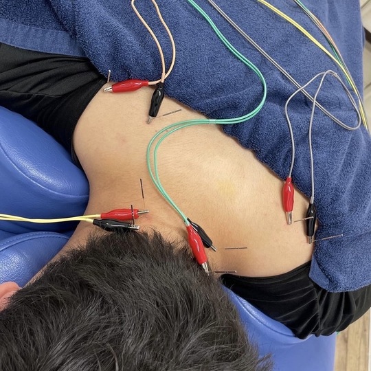 首の筋肉、関節が炎症している場所に電気鍼を行っている