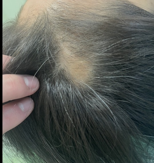 40歳代女性の円形脱毛症　薄毛改善鍼のBefore